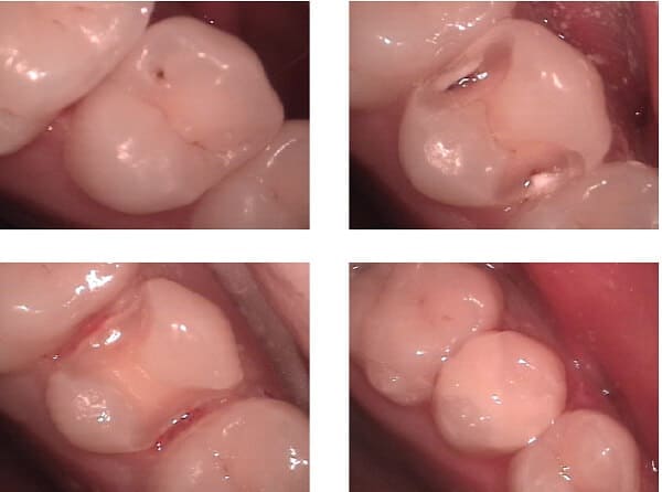 What To ﻿Do If Your Tooth Filling Falls Out