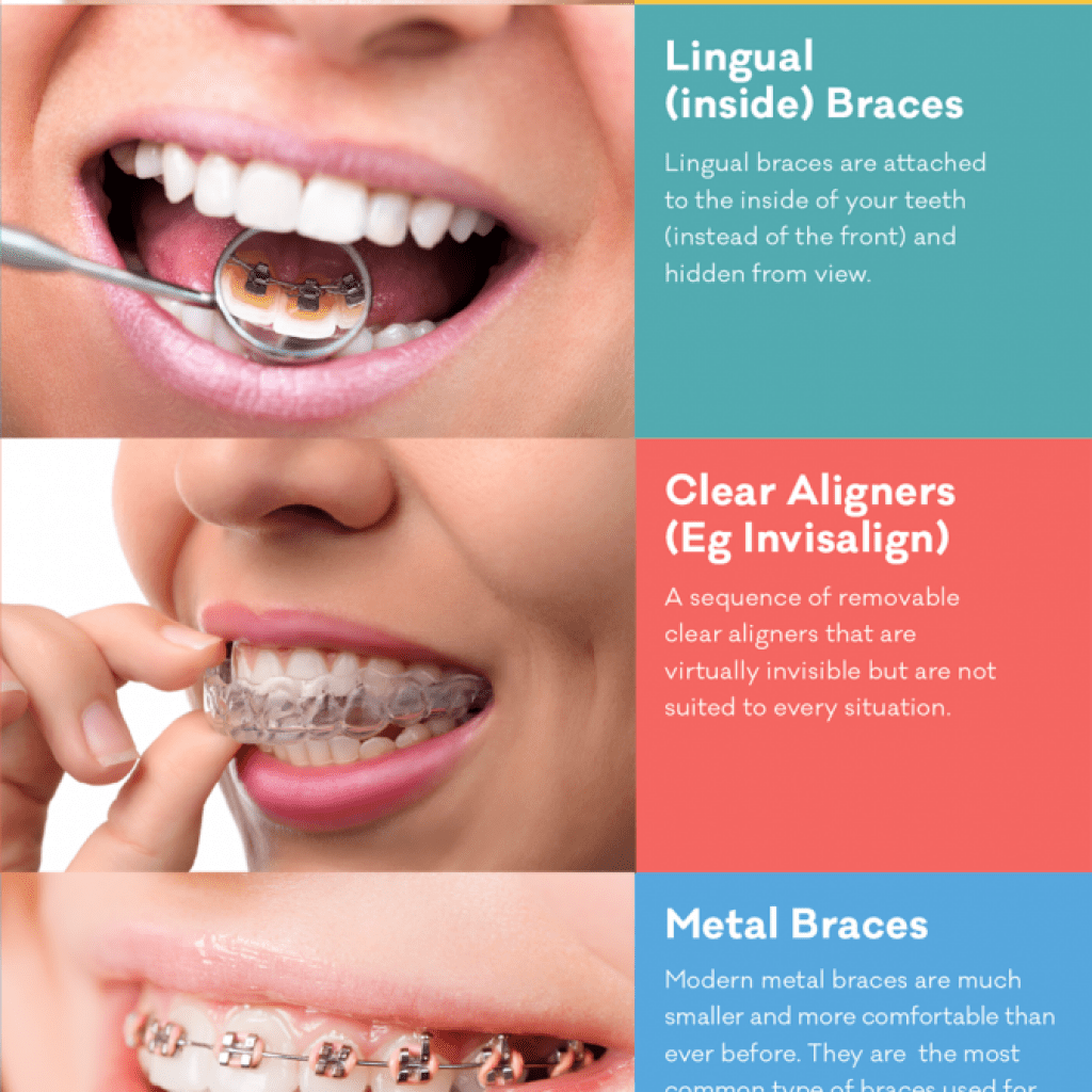 types of braces info straighten teeth without braces