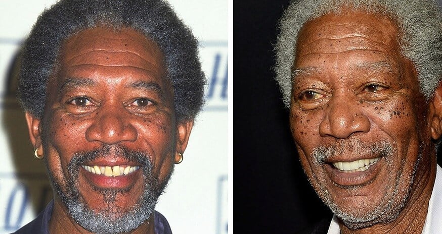 morgan freeman celebrity teeth makeover before and after