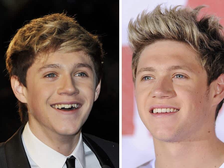 Niall horan before and after braces and dental work