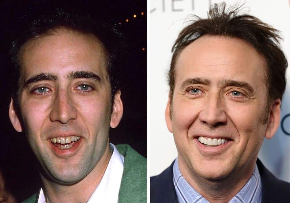 nick cage teeth before and after dentistry