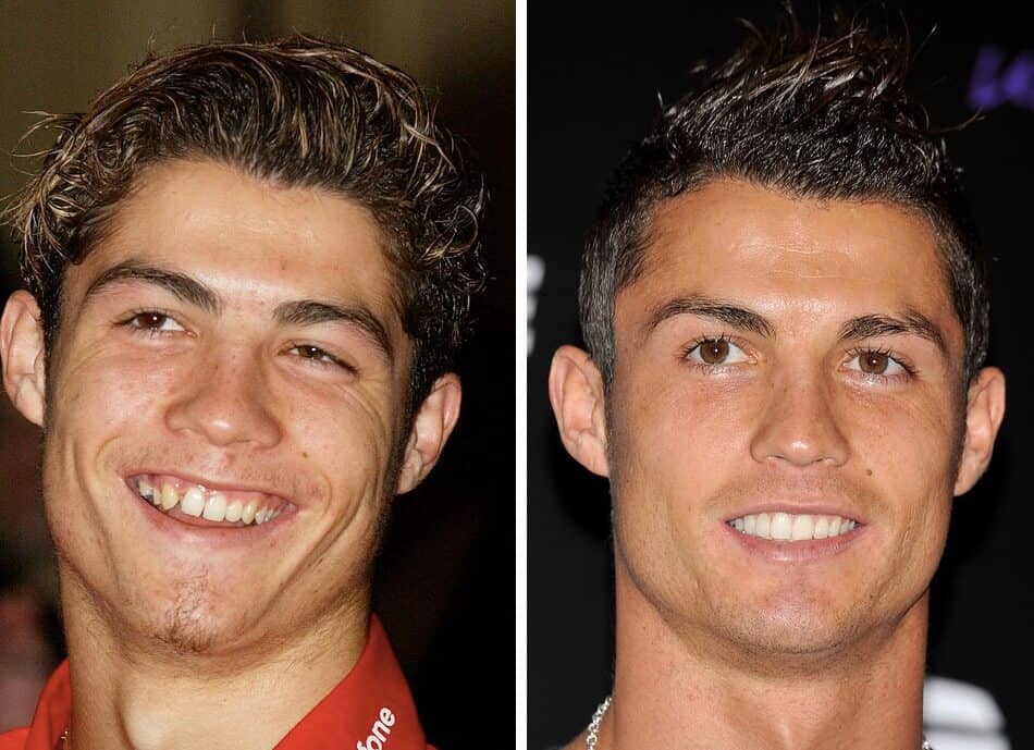 ronaldo before and after dental work