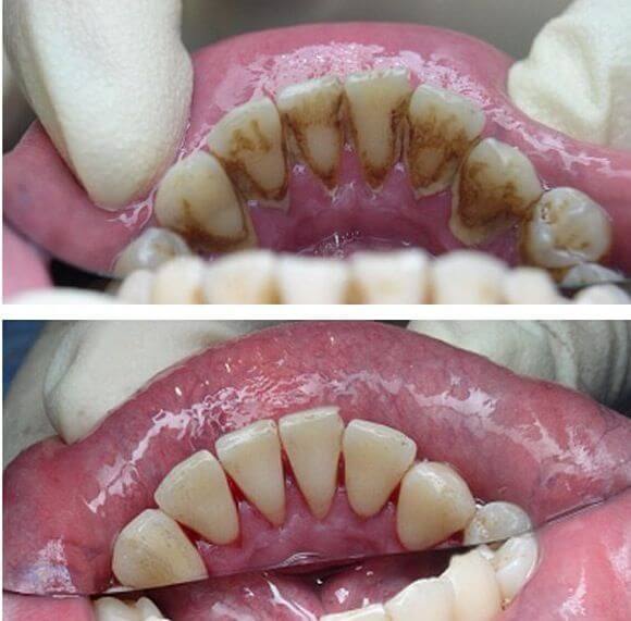 before and after teeth clean