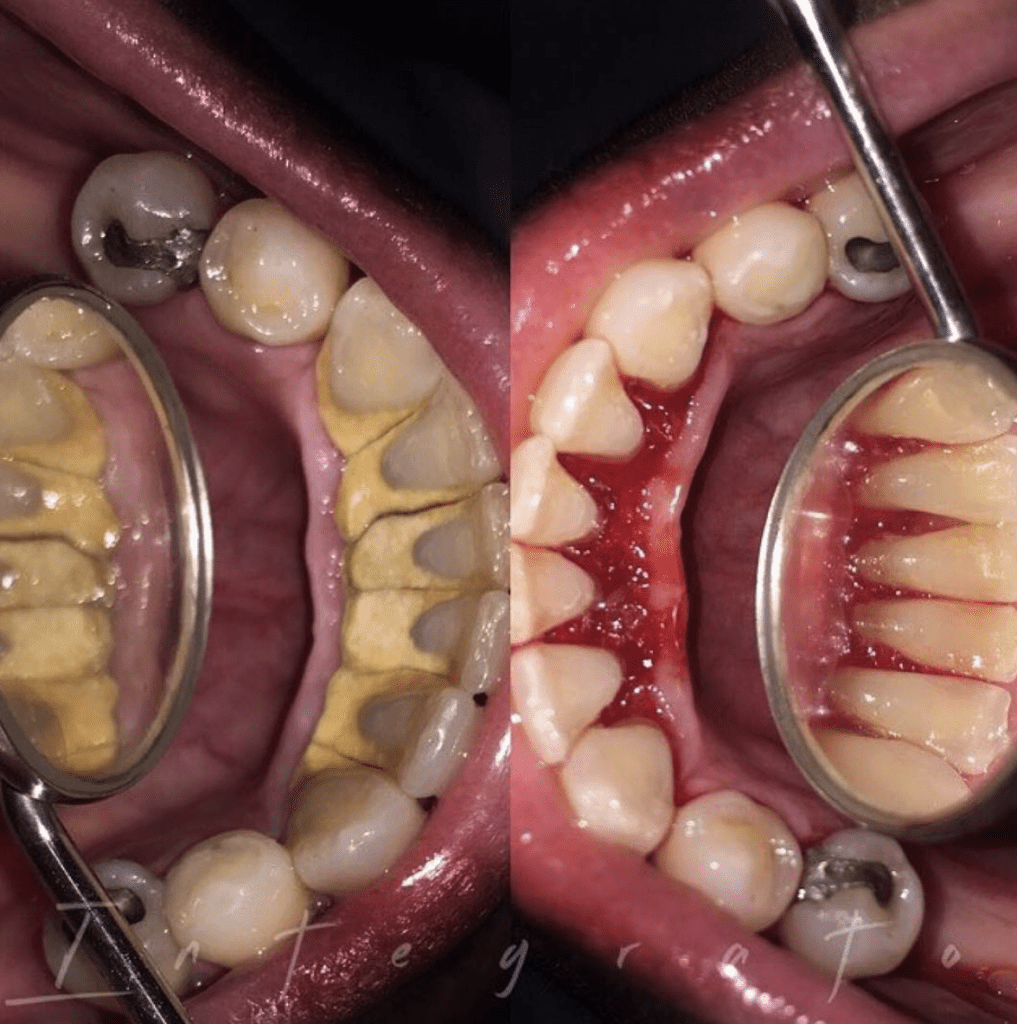 scraping black stuff off teeth calculus