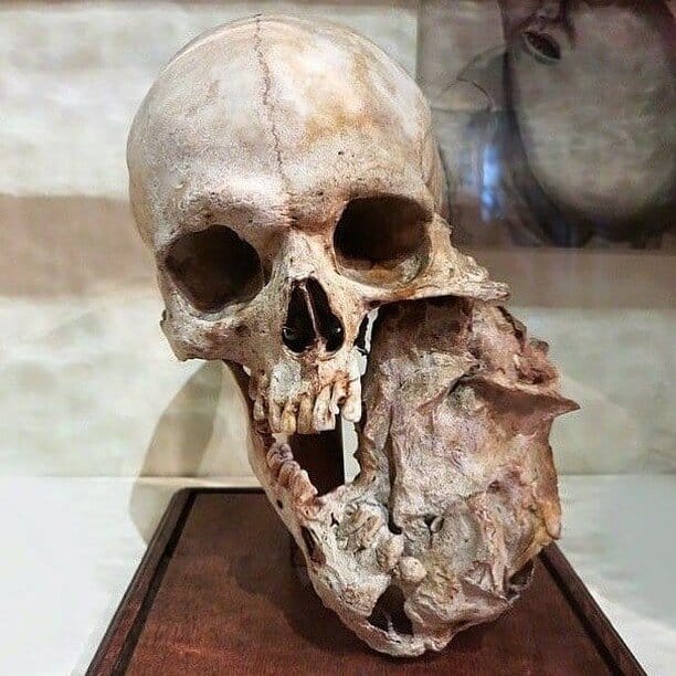 a skull with a large tumour